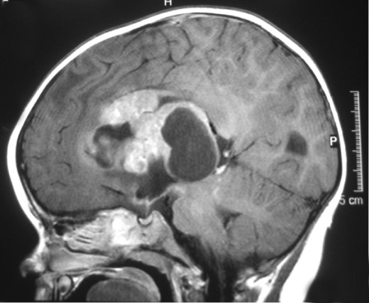 فیلم رادیولوژی تومور مغزی اطفال